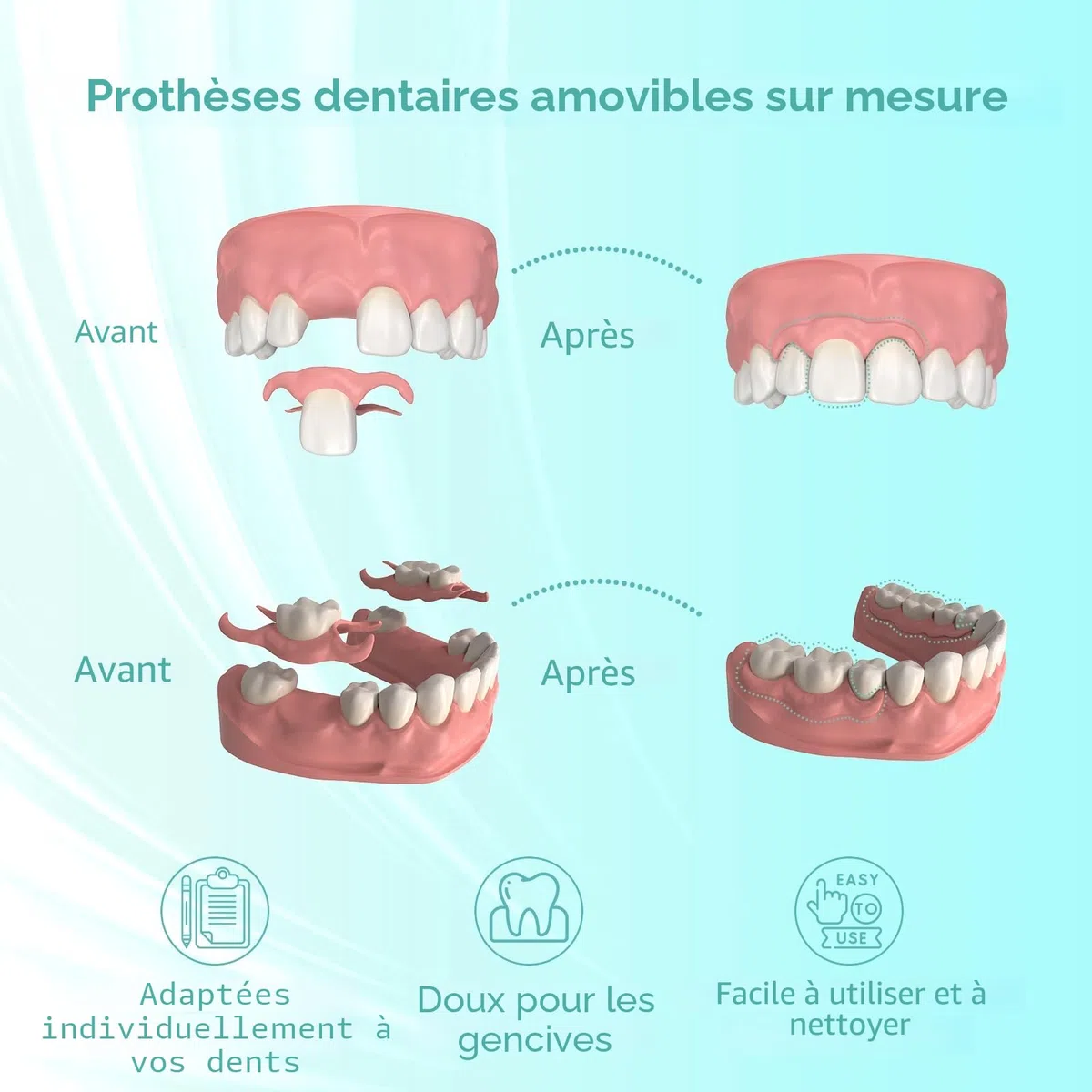 Prothèse Partielle Dentaire sur mesure - Dentier Provisoire, Prothese dentaire amovible et provisoire. Ajustement parfait et utilisation facile pour recréer votre sourire à domicile (3 dents)